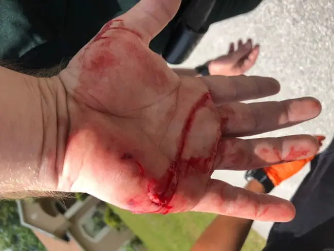 Flagler County Sheriff's deputy Jonathan Schmidt required stitches after being bitten on the hand by the same pit bull that bit Michelle Manfredi in Palm Coast's P Section. Schmidt was investigating that bite when he was attacked. (FCSO)