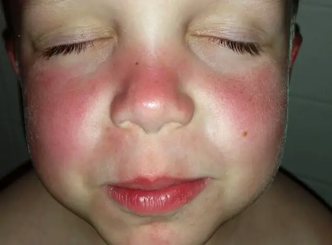 sunburn sunscreen