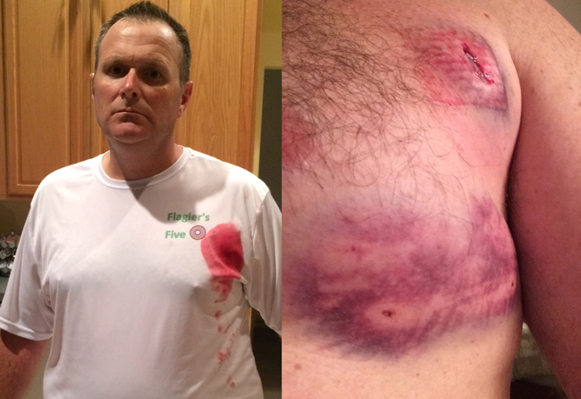 Cmdr. Steve Cole, a 20-year veteran of the Flagler County Sheriff's Office, after he was attacked Monday evening by a dog on a path along Matanzas Woods Parkway. (Steve Cole)