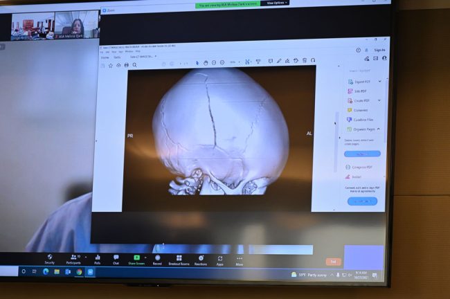 An X-ray of the child's skull fracture as shown on an overhead screen to the jury on Oct. 27. (© FlaglerLive)