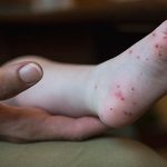 A CDC image of hos hand foot and mouth disease may present.