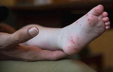A CDC image of hand, foot and mouth disease may present. 