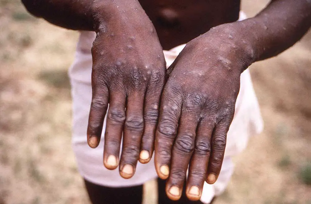 Een CDC-illustratie van de symptomen van apenpokken tijdens de herstelfase, in dit geval op handen van een jonge man in Congo. 