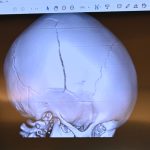 TT's skull fracture when he was 20 months old, as shown to the jury in the trial of Deviaun Toler, 29, who was found guilty of aggravated child abuse at the end of October in a trial in Bunnell. (© FlaglerLive)