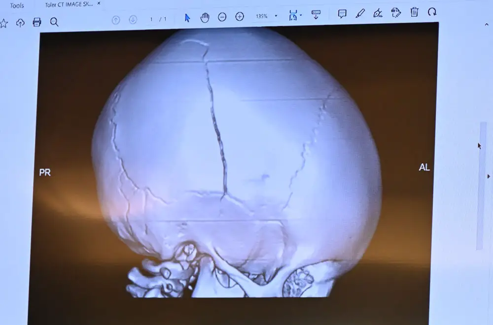 TT's skull fracture when he was 20 months old, as shown to the jury in the trial of Deviaun Toler, 29, who was found guilty of aggravated child abuse at the end of October in a trial in Bunnell. (© FlaglerLive)