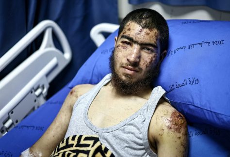 Eighteen-year-old Palestinian Owais Hammam recovers in a hospital after an alleged kidnap and assault by Israeli settlers